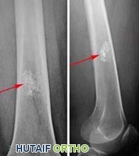 الورم الغضروفي الداخلي (Enchondroma): دليل شامل للمرضى مع الأستاذ الدكتور محمد هطيف