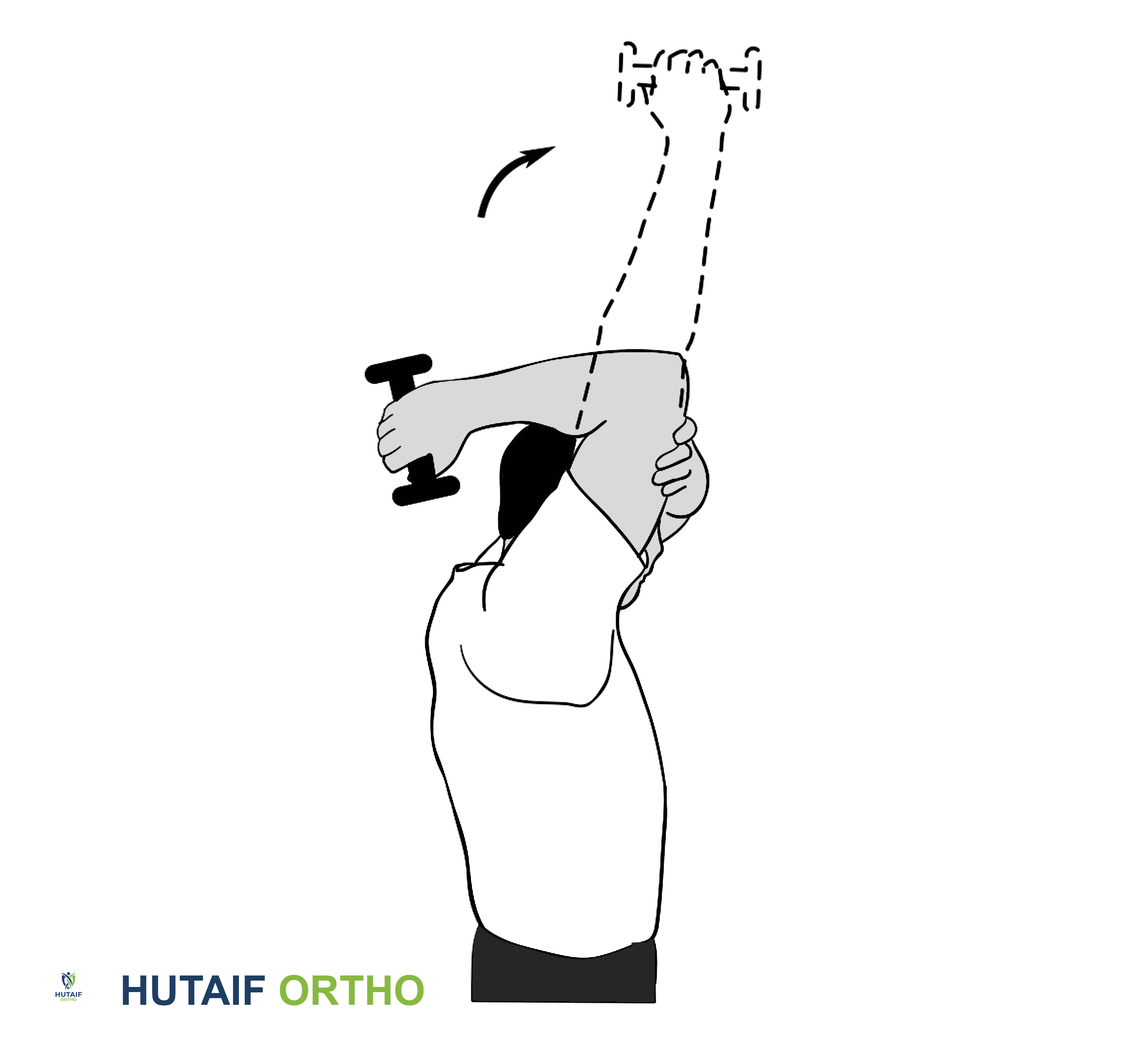 صورة طبية: تمزق الكفة المدورة بالكتف: دليلك الشامل للعلاج والتعافي مع الأستاذ الدكتور محمد هطيف في صنعاء