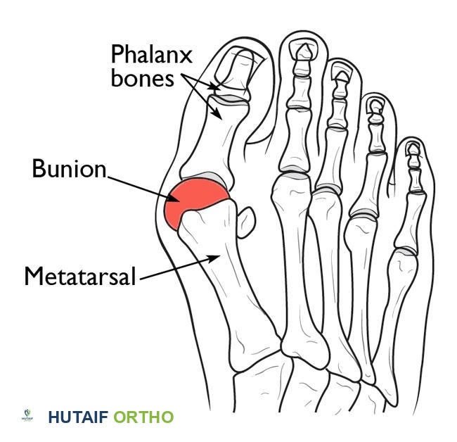 التهاب المفصل المشطي السلامي MTP