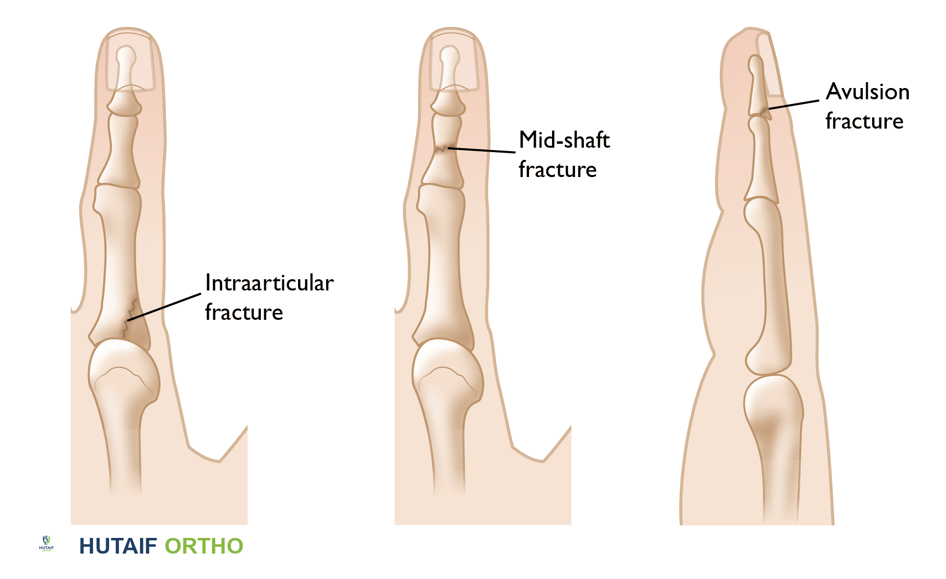 أنواع كسور الأصابع