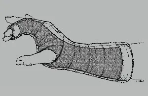 Radial Gutter Splint