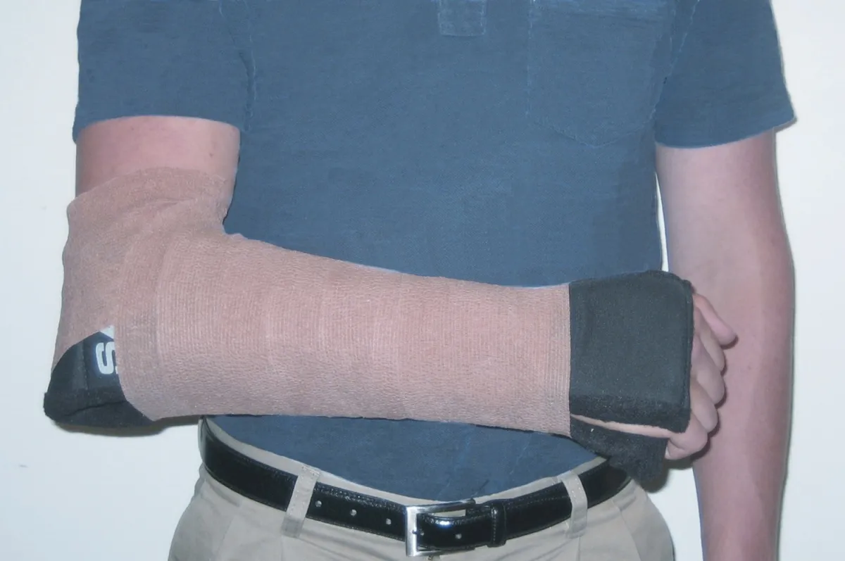 Sugar Tong Splint