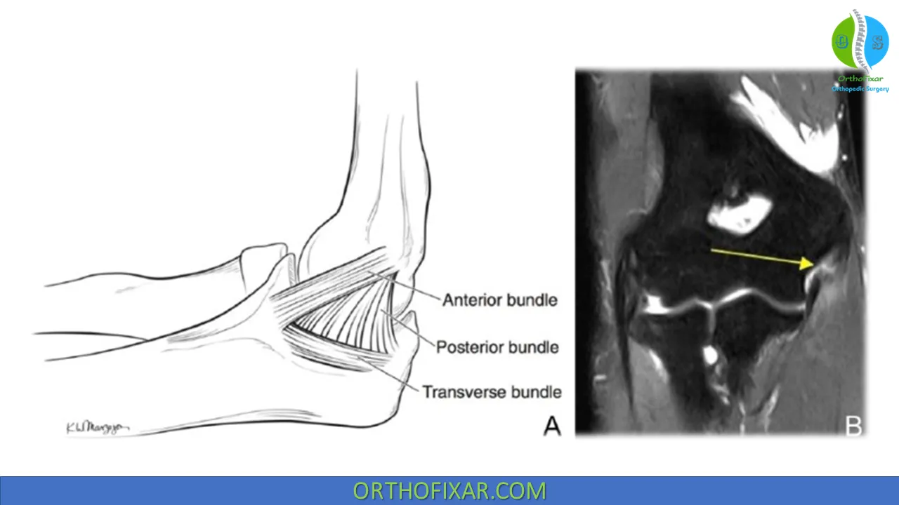 Ulnar Collateral Ligament (UCL) Elbow Brace