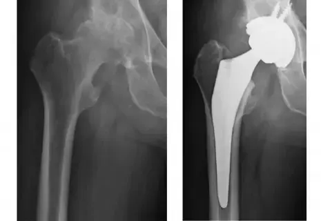 صورة أشعة قبل وبعد زراعة مفصل الورك للسيد ياسر، تُظهر المفصل الصناعي في مكانه الصحيح