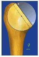 Orthopedic Prometric MCQs - Chapter 3 Part 48