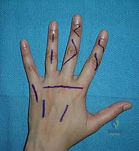 Illustration of radial post interosseous - Dr. Mohammed Hutaif