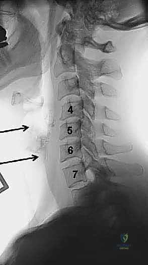 مقارنة العلاجات لمشاكل الرقبة