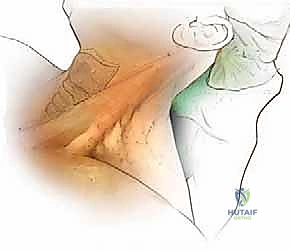 جراحة الفقرات العنقية الأمامية: دليل شامل للمرضى مع الأستاذ الدكتور محمد هطيف