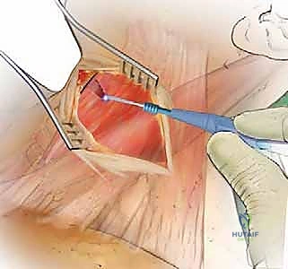 أعراض الانزلاق الغضروفي في الرقبة