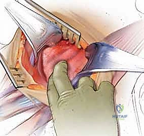 الشق الجراحي التجميلي في الرقبة