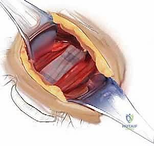 خطوات جراحة الفقرات العنقية