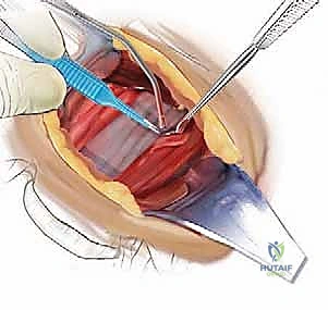زرع القفص الكربوني في الرقبة