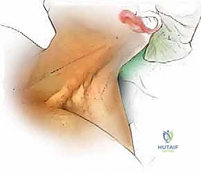استعادة الحركة بعد جراحة الرقبة