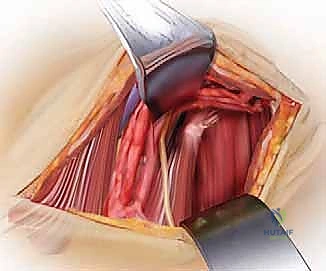 العلاج الطبيعي بعد الجراحة