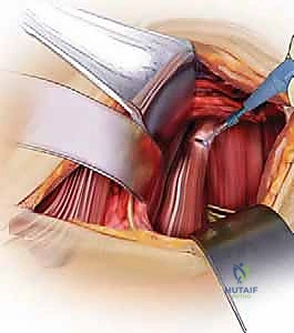 فترة التعافي بعد جراحة الرقبة