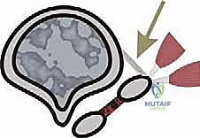 تشريح عظام القدم والمفاصل المتعلقة بعملية شيفرون