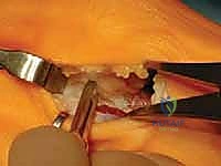 تفاصيل الأربطة والأوتار في مفصل إصبع القدم الكبير