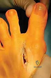 قياس الزوايا الشعاعية لتحديد شدة إبهام القدم الأروح - صورة 2