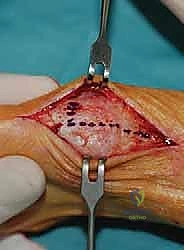 الأعراض السريرية والألم المرتبط بإبهام القدم الأروح