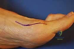 الأسباب الشائعة وعوامل الخطر لتشوه إبهام القدم الأروح