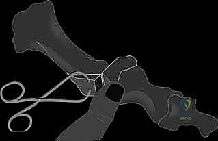 صورة توضيحية لـ عملية شيفرون البعيدة: حل شامل لتصحيح إبهام القدم الأروح مع الأستاذ الدكتور محمد هطيف في صنعاء