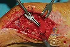 صورة توضيحية لـ عملية شيفرون البعيدة: حل شامل لتصحيح إبهام القدم الأروح مع الأستاذ الدكتور محمد هطيف في صنعاء