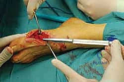 صورة طبية: عملية شيفرون البعيدة: حل شامل لتصحيح إبهام القدم الأروح مع الأستاذ الدكتور محمد هطيف في صنعاء