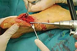 صورة طبية: عملية شيفرون البعيدة: حل شامل لتصحيح إبهام القدم الأروح مع الأستاذ الدكتور محمد هطيف في صنعاء