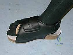 صورة طبية: عملية شيفرون البعيدة: حل شامل لتصحيح إبهام القدم الأروح مع الأستاذ الدكتور محمد هطيف في صنعاء