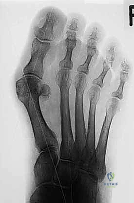 صورة طبية: عملية شيفرون البعيدة: حل شامل لتصحيح إبهام القدم الأروح مع الأستاذ الدكتور محمد هطيف في صنعاء