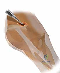 أعراض كسور الحوض
