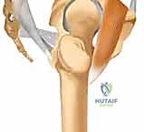 أشعة سينية توضح كسر الحوض