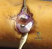 Illustration of forearm shaft fractures - Dr. Mohammed Hutaif