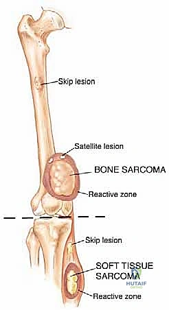 التشخيص الدقيق لأورام العظام