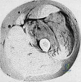 صورة توضيحية لـ دليل شامل لاستئصال الساركوما: فهم البيولوجيا، تحديد المراحل، ومبادئ الحفاظ على الأطراف مع الأستاذ الدكتور محمد هطيف