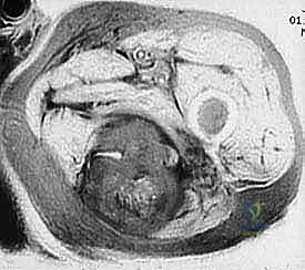 مقدمة في جراحة الساركوما والتخطيط الجراحي