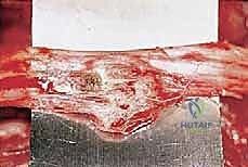 صورة طبية: دليل شامل لاستئصال الساركوما: فهم البيولوجيا، تحديد المراحل، ومبادئ الحفاظ على الأطراف مع الأستاذ الدكتور محمد هطيف