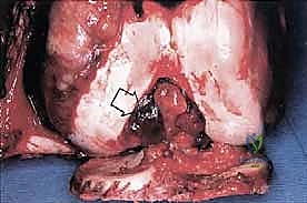 الجراحة الميكروسكوبية