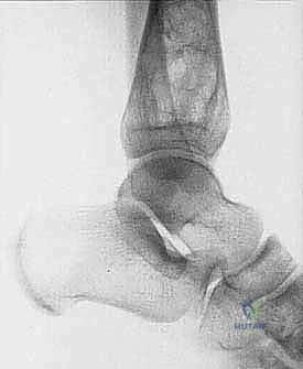 تحديد هوامش الاستئصال