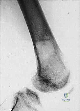 صورة توضيحية لـ دليل شامل لاستئصال الساركوما: فهم البيولوجيا، تحديد المراحل، ومبادئ الحفاظ على الأطراف مع الأستاذ الدكتور محمد هطيف