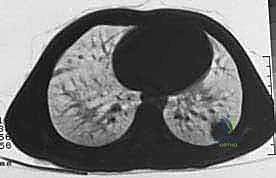 صورة توضيحية لـ دليل شامل لاستئصال الساركوما: فهم البيولوجيا، تحديد المراحل، ومبادئ الحفاظ على الأطراف مع الأستاذ الدكتور محمد هطيف