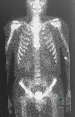 صورة توضيحية لـ دليل شامل لاستئصال الساركوما: فهم البيولوجيا، تحديد المراحل، ومبادئ الحفاظ على الأطراف مع الأستاذ الدكتور محمد هطيف