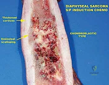 صورة طبية: دليل شامل لاستئصال الساركوما: فهم البيولوجيا، تحديد المراحل، ومبادئ الحفاظ على الأطراف مع الأستاذ الدكتور محمد هطيف