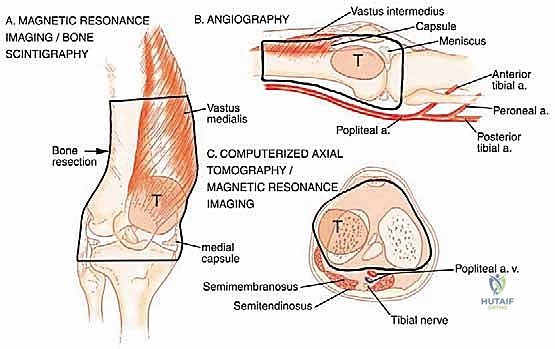 الكسور المرضية