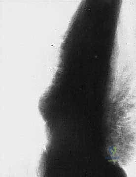 استعادة الحركة