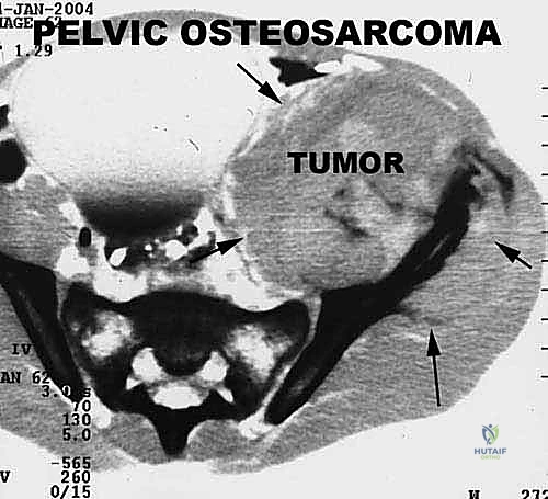 صورة توضيحية لـ دليل شامل لاستئصال الساركوما: فهم البيولوجيا، تحديد المراحل، ومبادئ الحفاظ على الأطراف مع الأستاذ الدكتور محمد هطيف