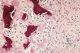 الاستئصال الواسع