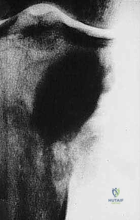 صورة طبية: دليل شامل لاستئصال الساركوما: فهم البيولوجيا، تحديد المراحل، ومبادئ الحفاظ على الأطراف مع الأستاذ الدكتور محمد هطيف