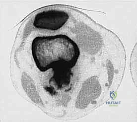 استئصال الورم