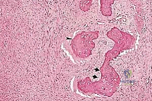 صورة طبية: دليل شامل لاستئصال الساركوما: فهم البيولوجيا، تحديد المراحل، ومبادئ الحفاظ على الأطراف مع الأستاذ الدكتور محمد هطيف